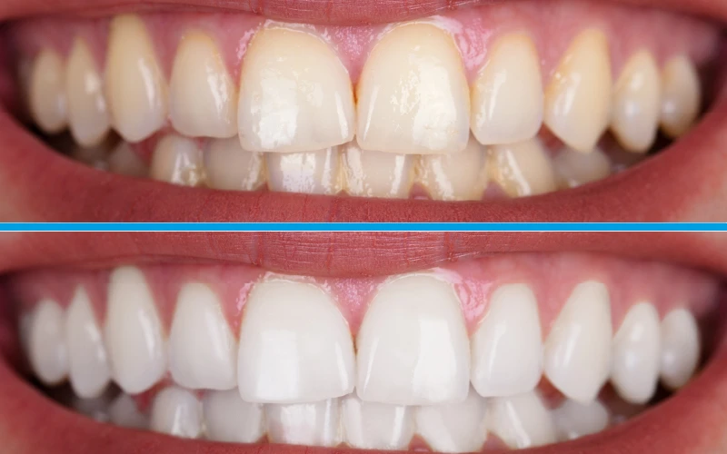 Clareamento DentalO clareamento dental é uma forma incrível de dar um brilho renovado ao seu sorriso, eliminando manchas e deixando seus dentes mais brancos.